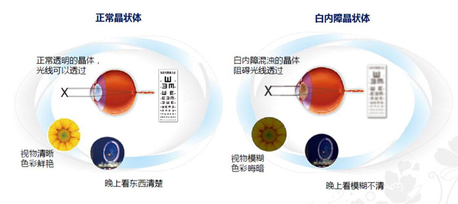 白内障和老花眼区别