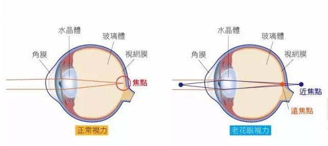 白内障和老花眼区别，老花眼发病率正呈现年轻化趋势