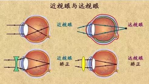 近视就不会老花了吗？