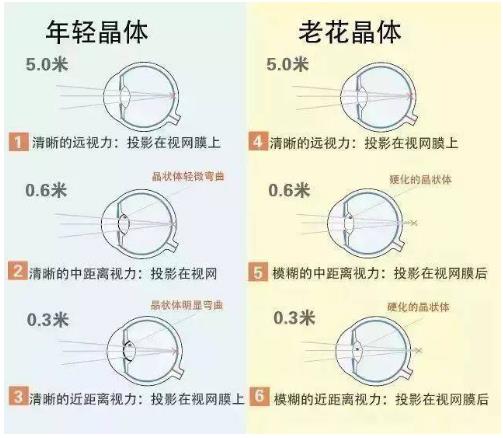 近视就不会老花了吗？