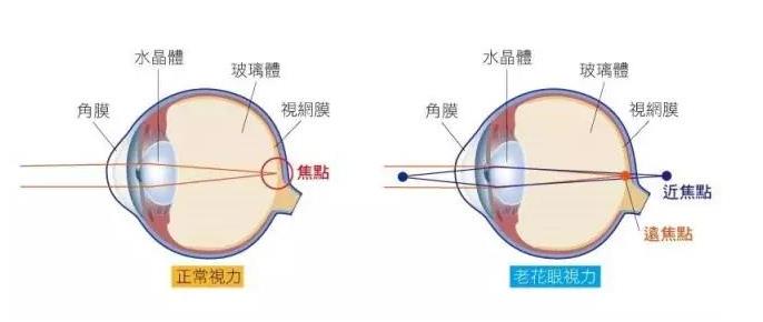 什么是渐进老花镜